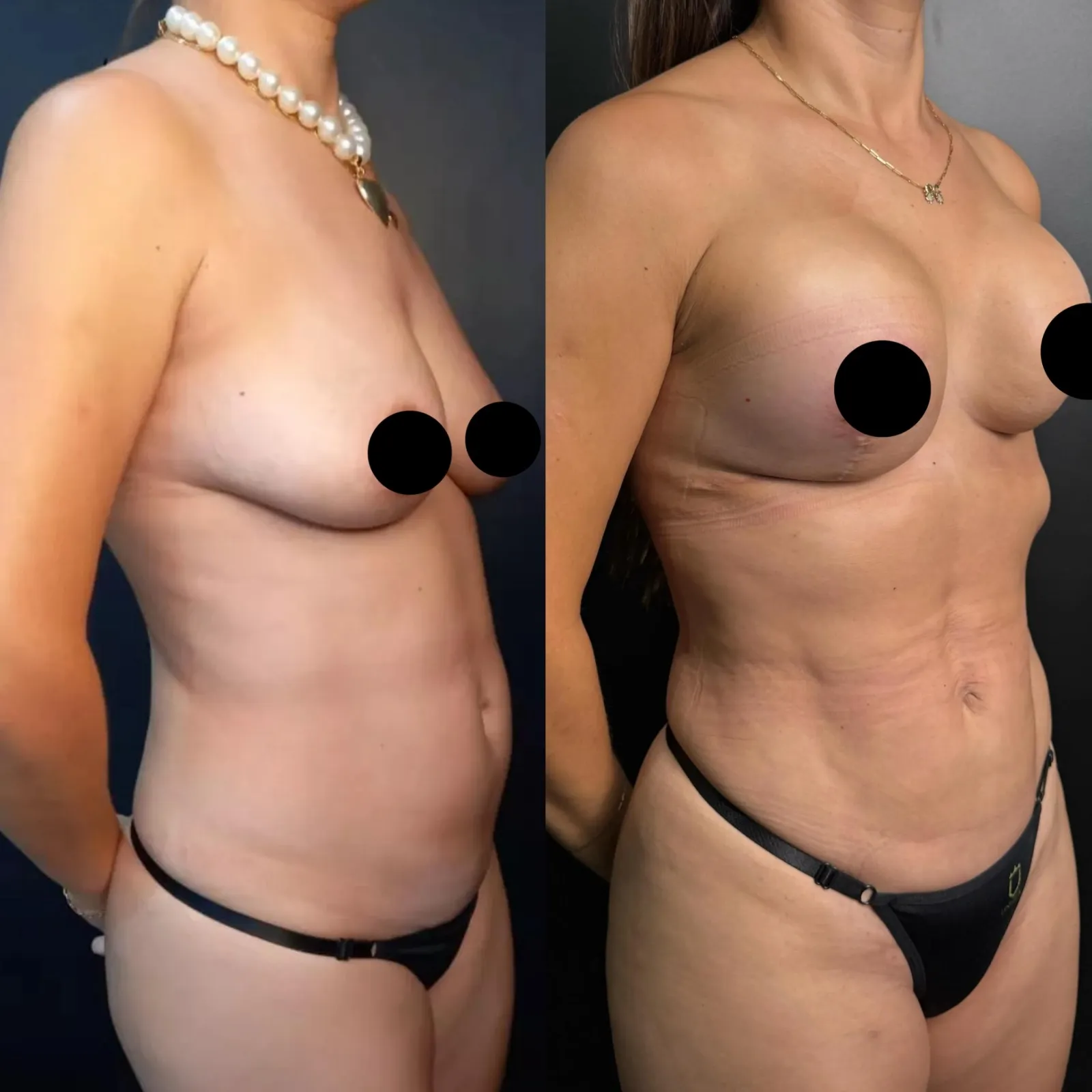 Antes e depois de plicatura de diástase pela Técnica Milla